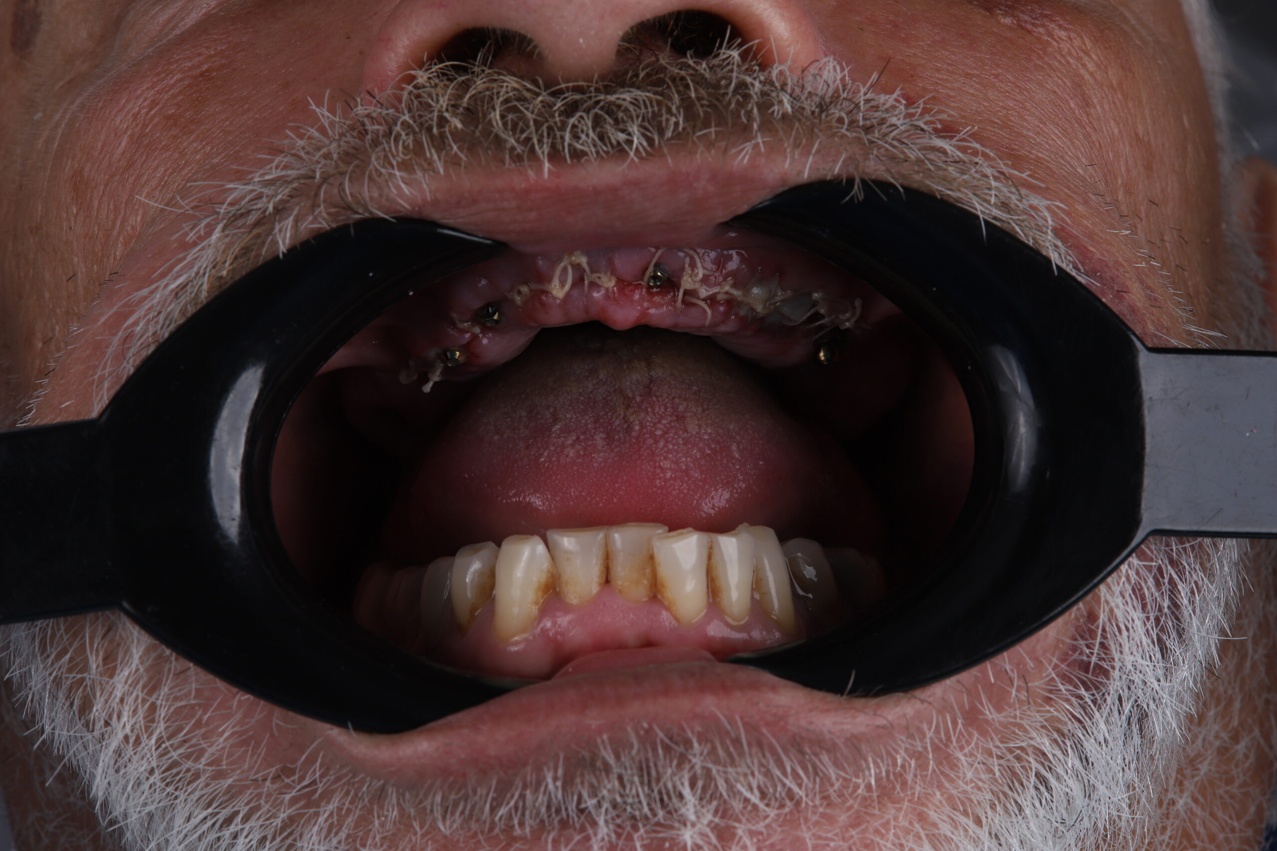 Full mouth rehabilitation before and after preview