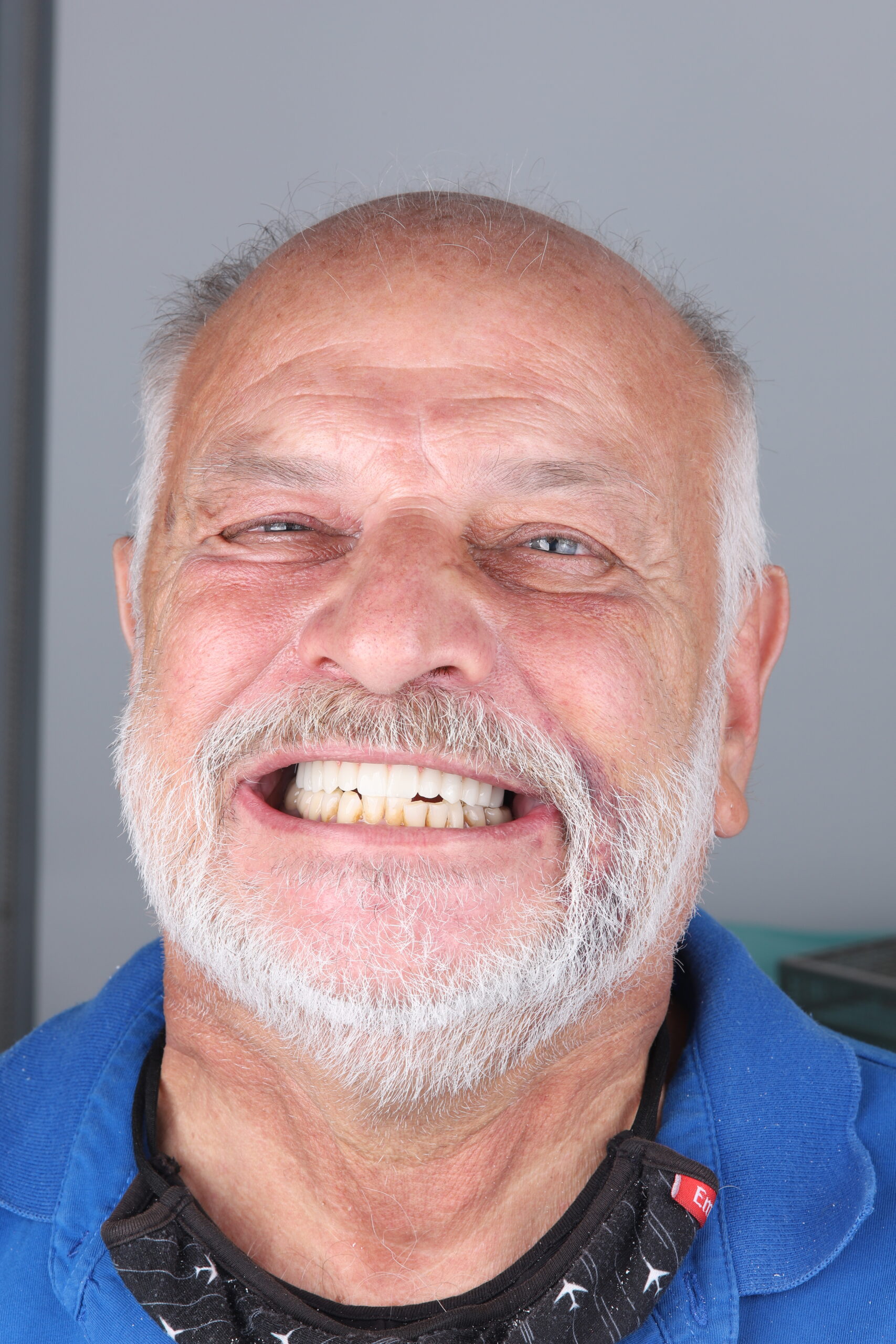 After—reconstructed smile and bite