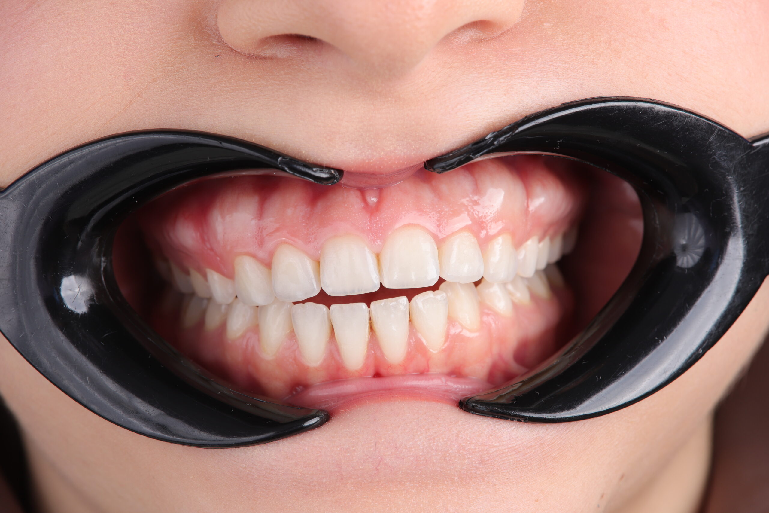 Before—excessive gingival display