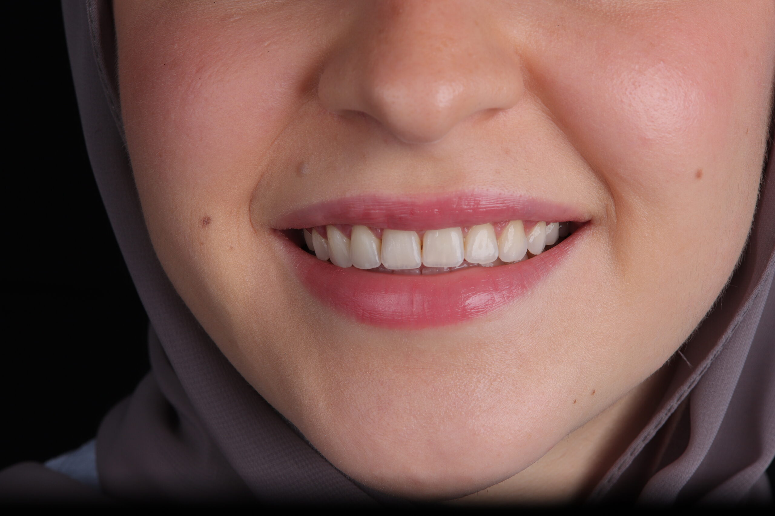 Gummy smile correction before and after preview