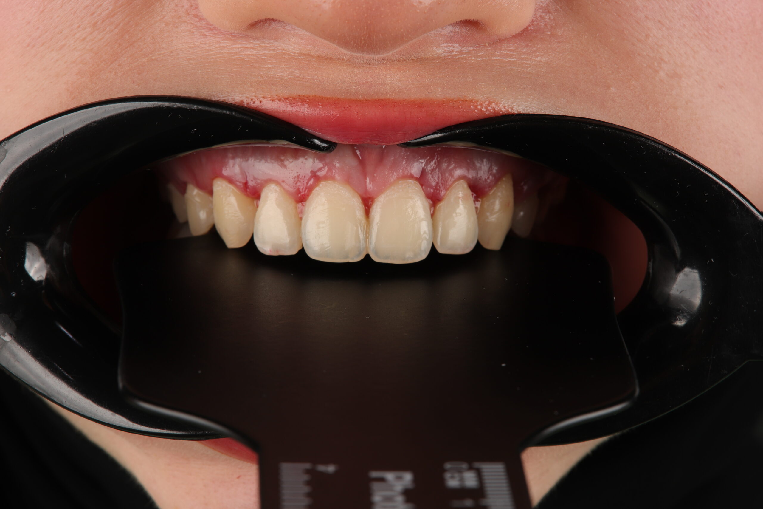 Luxury Smile Makeover illustration