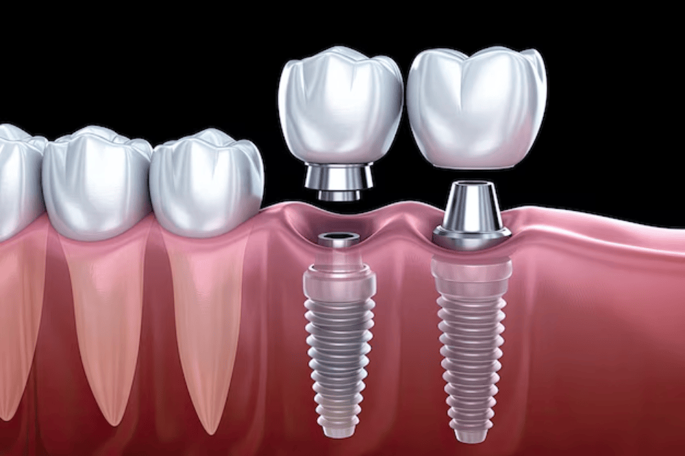 Dental implant planning and placement preview