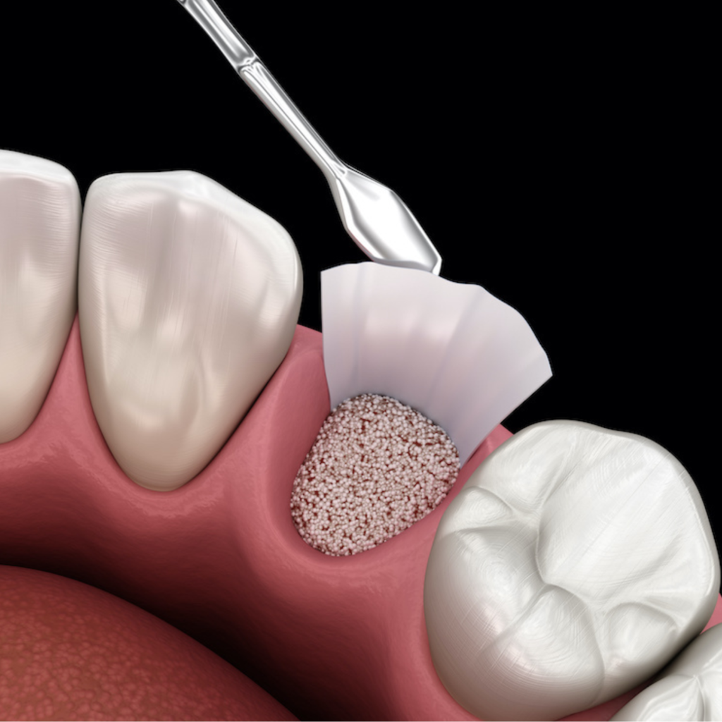 bone grafting procedures 3