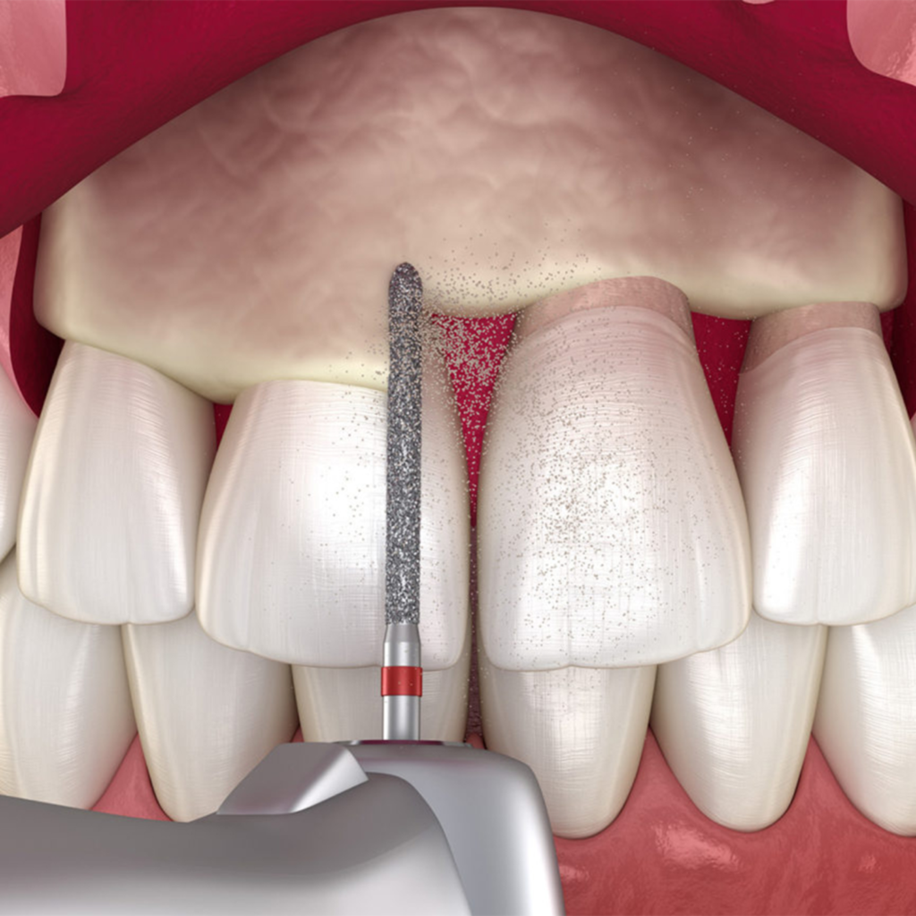crown lengthening (functional & aesthetic)