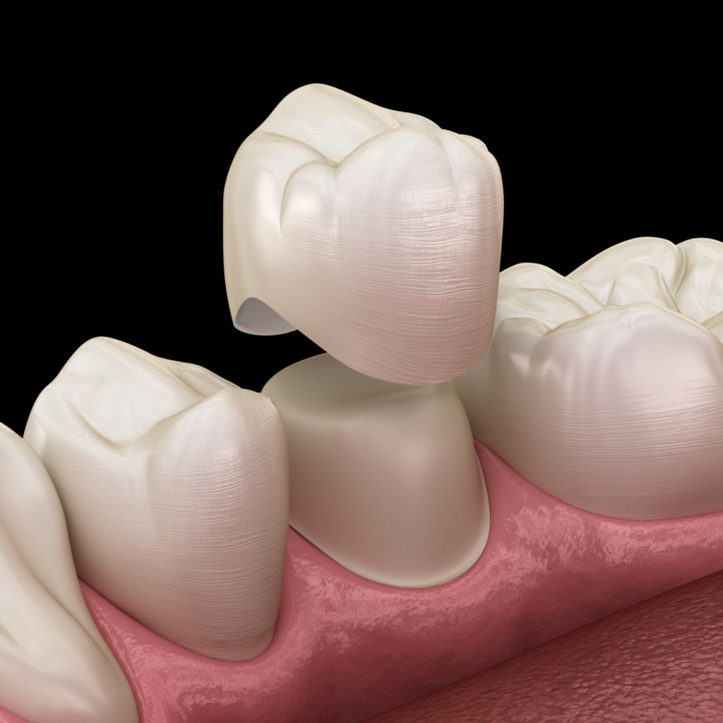 dental crowns