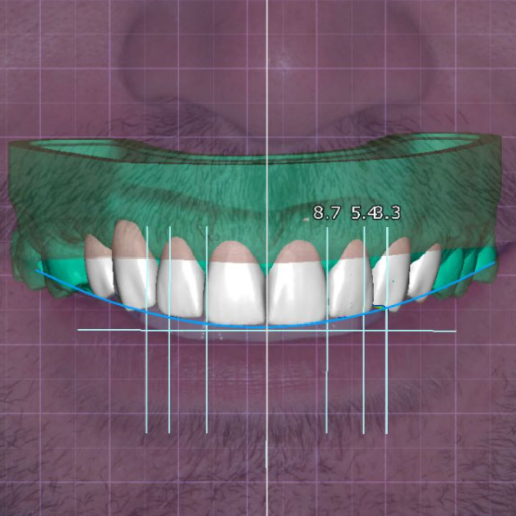 digital smile design