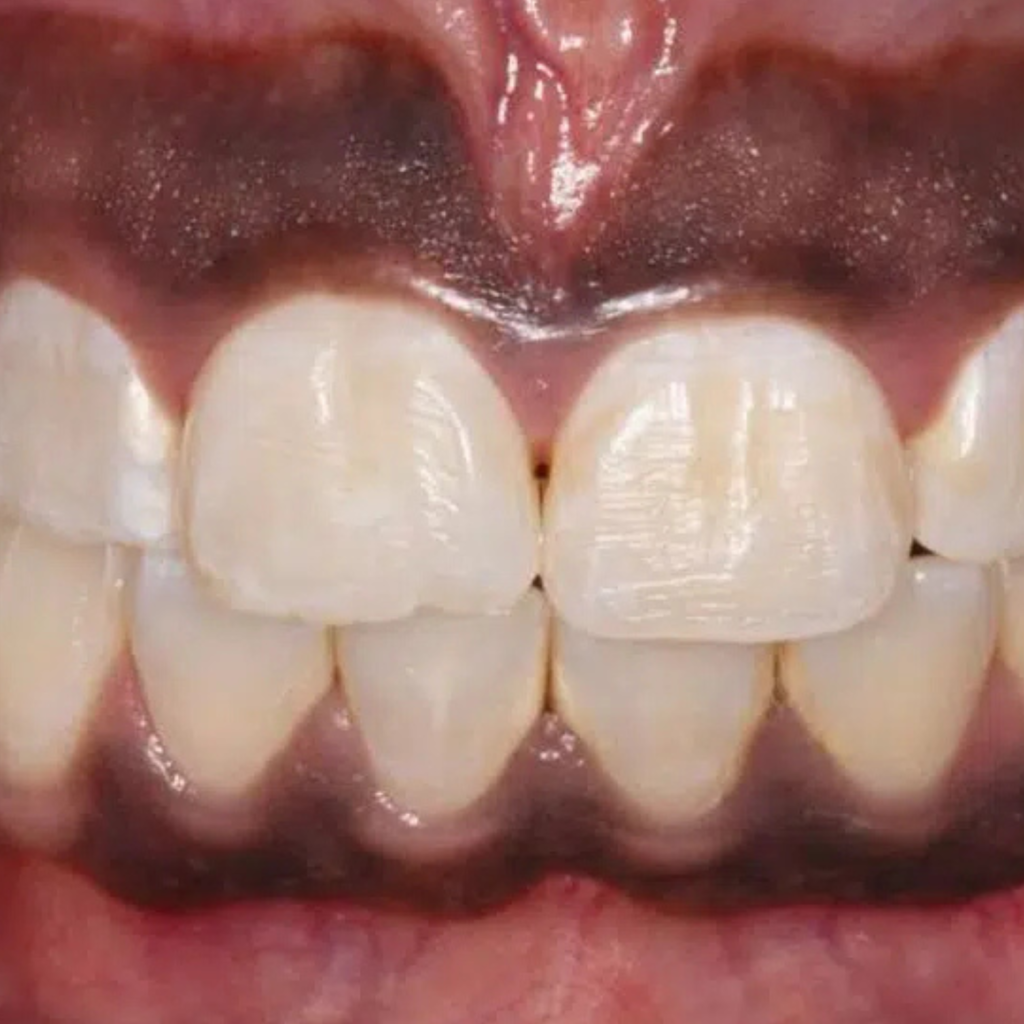 gum depigmentation