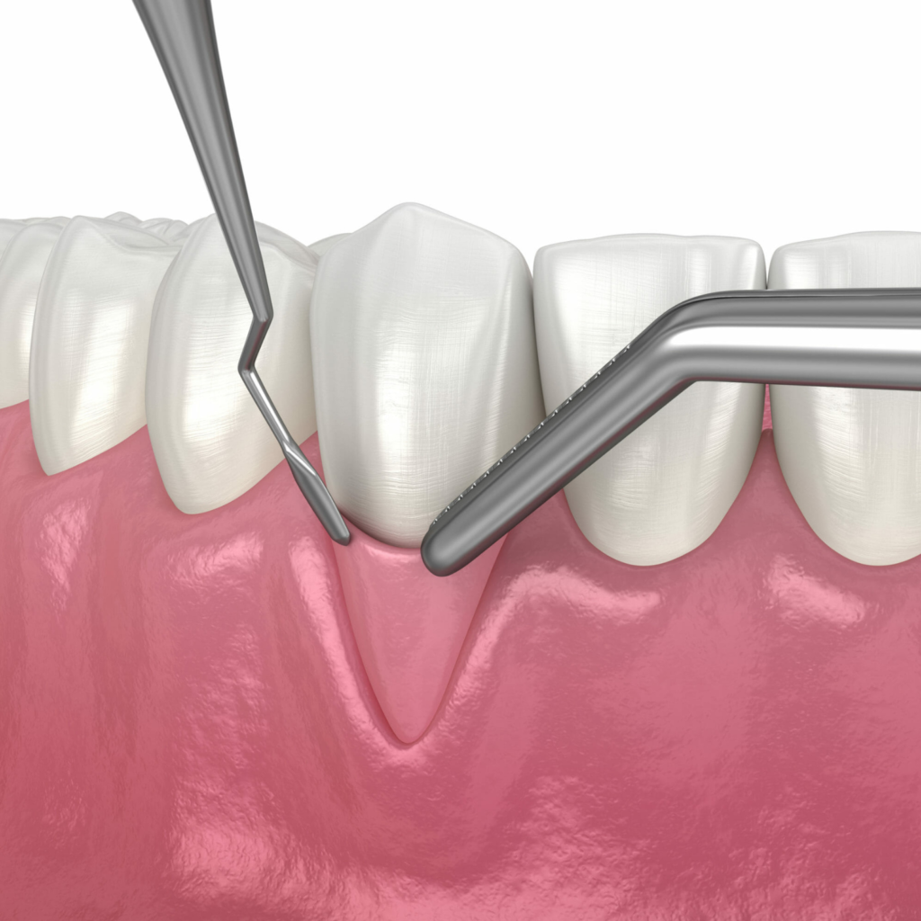 gum grafting (soft tissue augmentation)