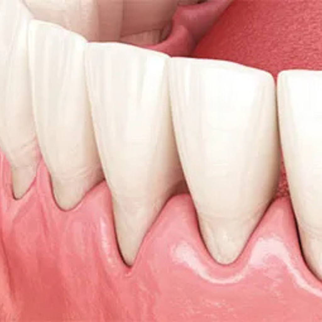 gum grafting (soft tissue augmentation)1