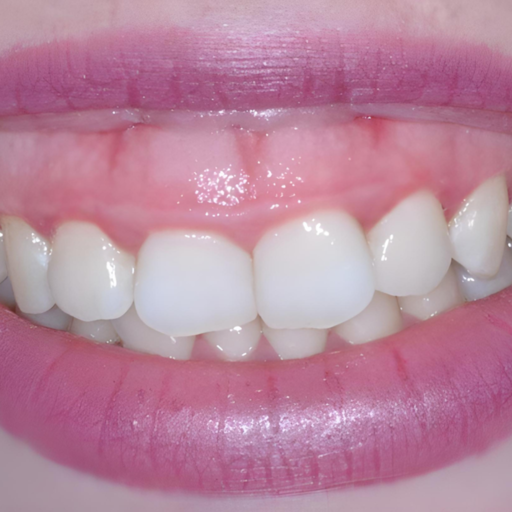 gummy smile correction