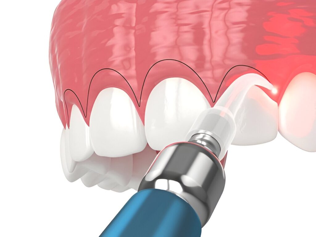 gingivectomy in san antonio and new braunfels